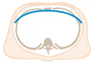 Nuss Procedure Bar Flipped