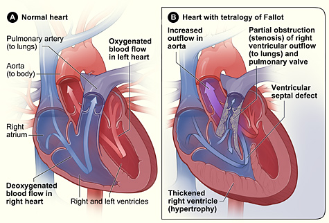 tetralogy_fallot