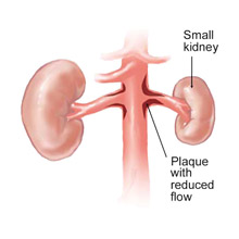 Renal Stenosis